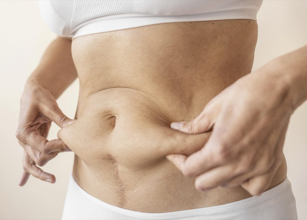 Mulher avaliando o abdômen, ilustrando sintomas de diástase abdominal